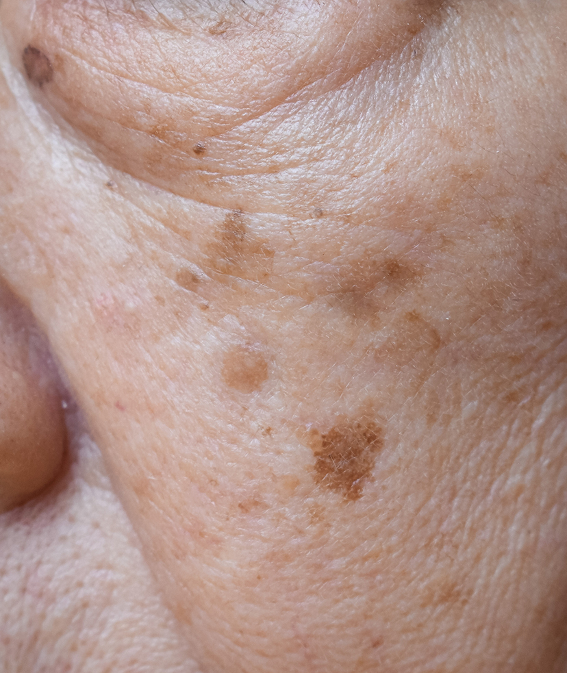 What are Age Spots? How Can You Treat Them?